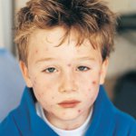 Molluscum contagiosum chez les enfants