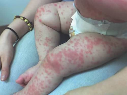 la scarlatine chez les enfants symptômes photos
