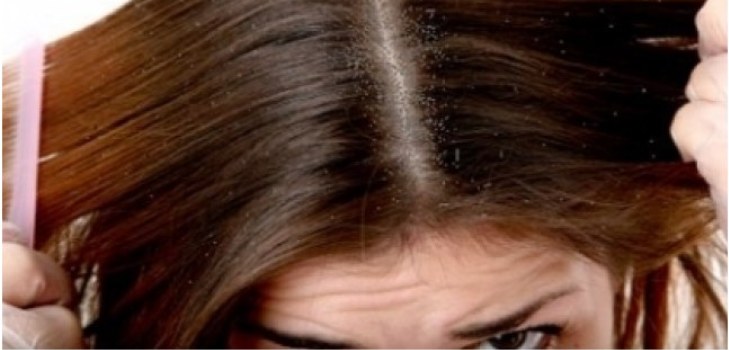 les cheveux avec les pellicules
