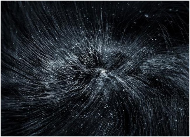 pellicules sur les cheveux