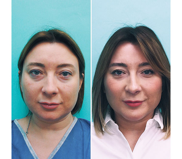 Lipolitiques pour le visage