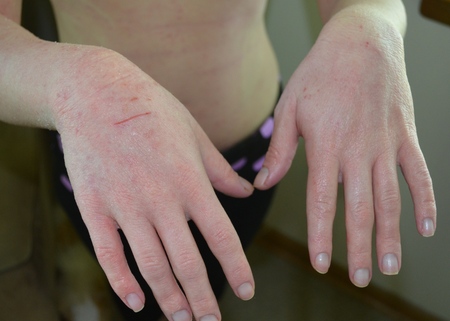 Les fissures dans les mains: les causes de l'apparence et le traitement avec des remèdes maison