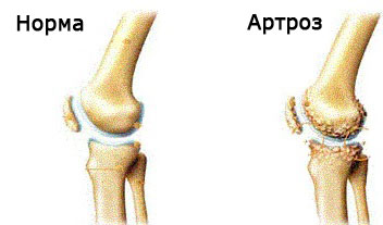 Traitement de l'arthrose populaire de l'articulation du genou