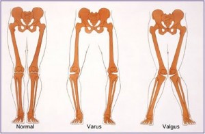 Traitement de l'arthrose populaire de l'articulation du genou