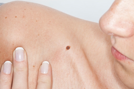 mole rouge sur la photo du corps