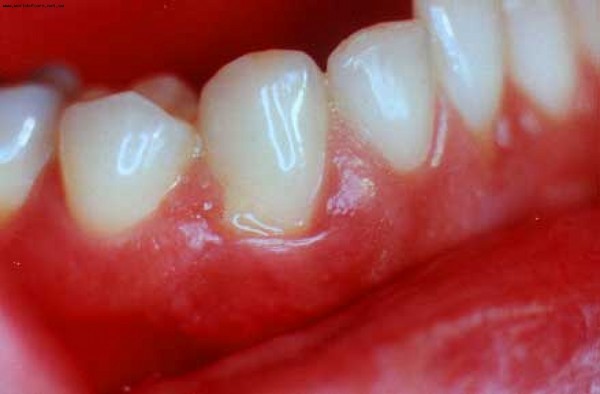 Qu'est-ce qui démange - les gencives ou les dents? Pourquoi se gratte-t-il les gencives chez les adultes? Comment se débarrasser de l'inconfort?