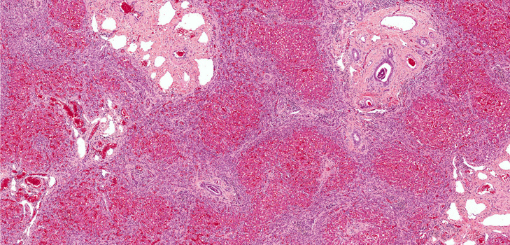 Qu'est-ce que la fibrose? Symptômes, photos, traitement