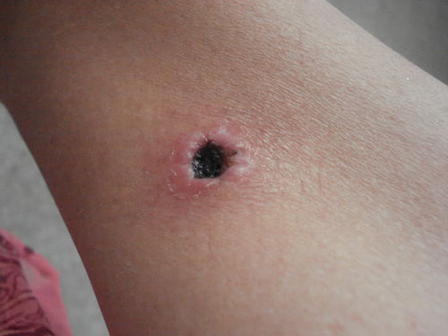 Qu'est-ce qu'une fistule? Symptômes, photos, traitement de la fistule