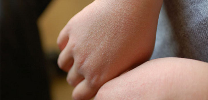 Nous nous débarrassons de la rougeur et de la rugosité des mains de l'enfant