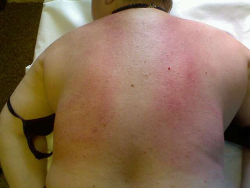 Devrait rester des ecchymoses après le massage
