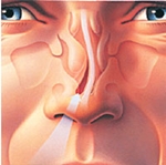 Comment traiter la courbure de la cloison nasale: chirurgie, correction laser