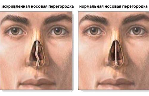 Comment traiter la courbure de la cloison nasale: chirurgie, correction laser