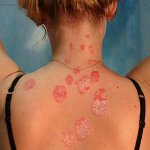 Comment traiter le psoriasis? Comment traiter le psoriasis?