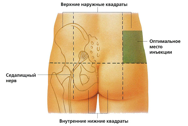 Comment faire une injection intramusculaire dans la fesse