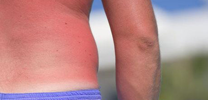 La peau est brûlée au soleil. Que devrais-je faire? Recettes, masques, astuces