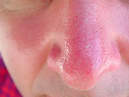 La peau est brûlée au soleil. Que devrais-je faire? Recettes, masques, astuces
