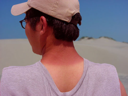 Que faire si la peau est brûlée