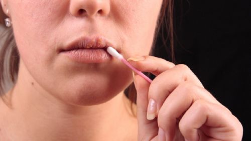 Des moyens efficaces pour traiter les rhumes sur les lèvres