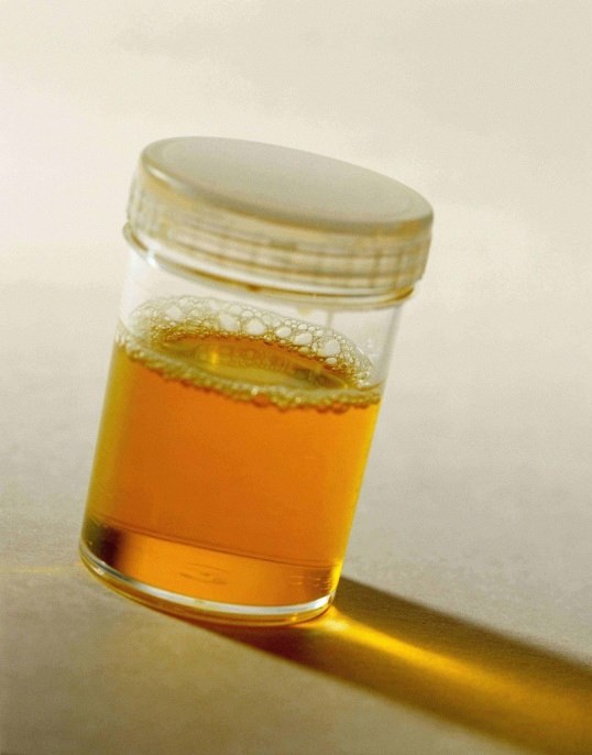 urine dans un bocal