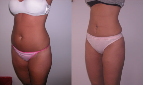 Liposuccion de l'abdomen et des cuisses: critiques, photos avant et après