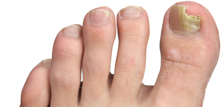 Les meilleurs remèdes pour les mycoses des ongles sur les jambes et les mains