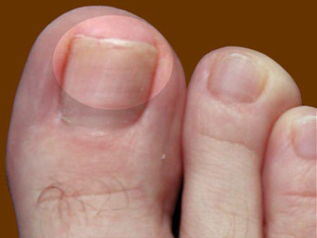 Les meilleurs remèdes pour les mycoses des ongles sur les jambes et les mains