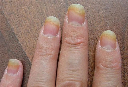 Les meilleurs remèdes pour les mycoses des ongles sur les jambes et les mains