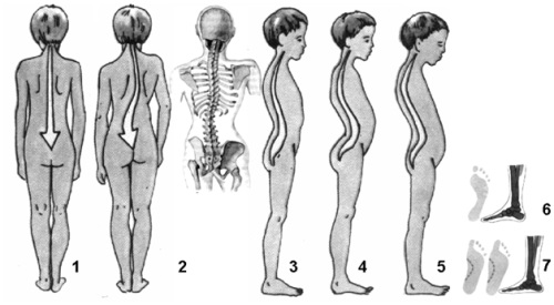 Massage avec scoliose chez les enfants