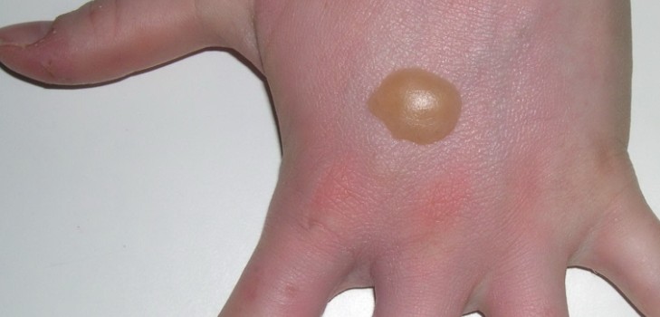 Des bulles d'eau apparaissent sur les paumes de vos mains: que faire