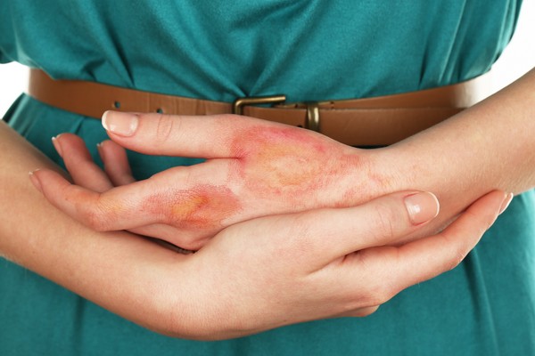 Des bulles d'eau apparaissent sur les paumes de vos mains: que faire