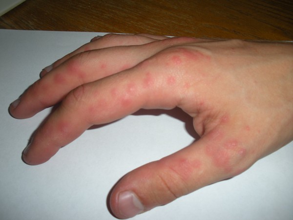 Des bulles d'eau apparaissent sur les paumes de vos mains: que faire