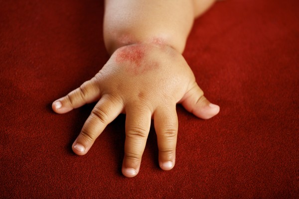 Des bulles d'eau apparaissent sur les paumes de vos mains: que faire