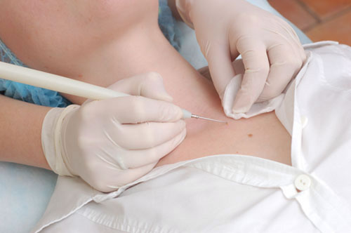 Des marques de naissance sur le corps et leurs dangers