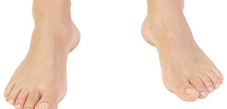 Pieds fortement moites. Que devrais-je faire?