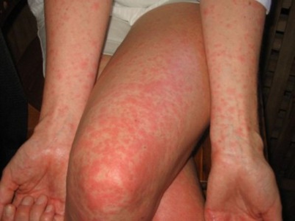 Eruptions chez les adultes: photos, causes des éruptions cutanées et astuces pour le traitement des éruptions cutanées