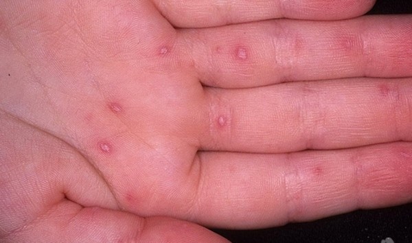 Eruptions chez les adultes: photos, causes des éruptions cutanées et astuces pour le traitement des éruptions cutanées