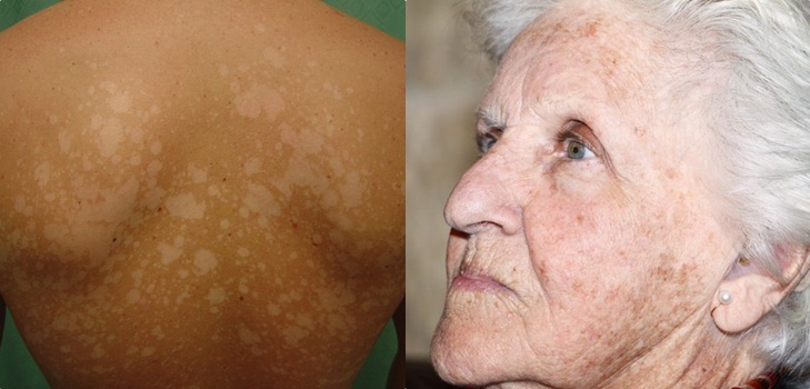 Sur la peau un peeling
