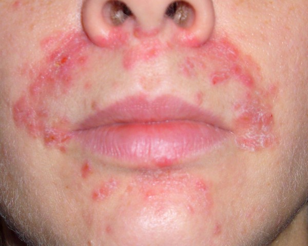 Sur la peau un peeling