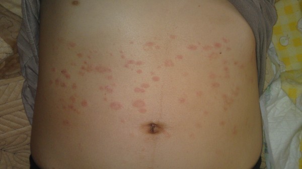 Sur la peau un peeling