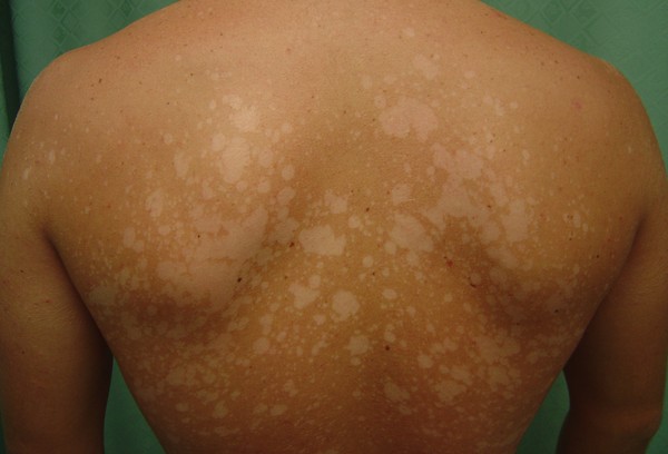 Sur la peau un peeling