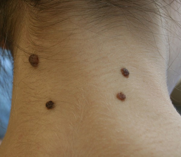 Sur la peau un peeling