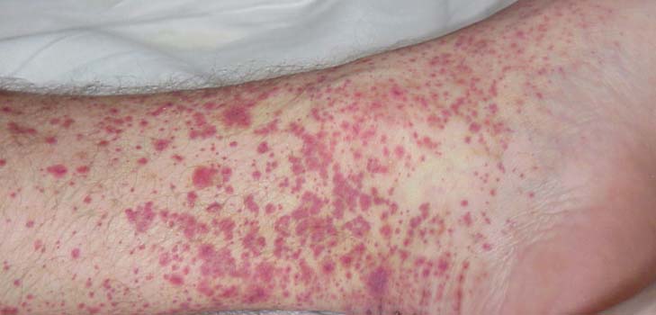 Vascularite - qu'est-ce que c'est? Symptômes, photos, traitement